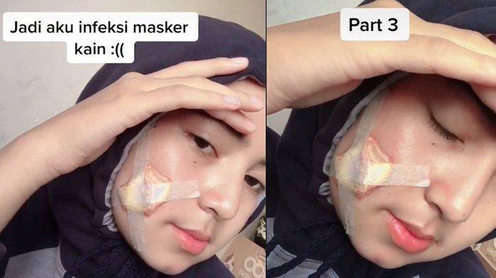 MASKER KAIN Membawa Petaka Cewek ini Kena Infeksi di Bagian Pipi Berujung Operasi